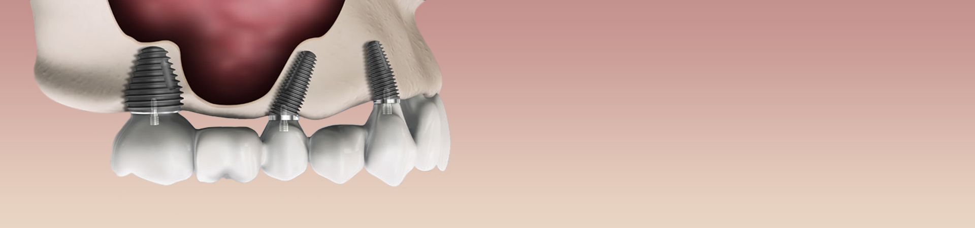 1920x450_WEB-HERO-BNR_dentalimplants.jpg