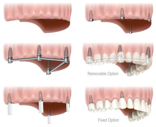 all-teeth-missing-implants.jpg